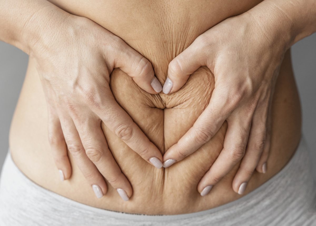 Quels résultats attendre d&rsquo;une abdominoplastie ?